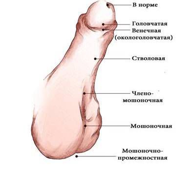 Формы гипоспадии