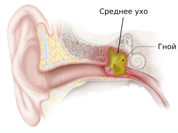 Гнойный средний отит: причины, симптомы и лечение