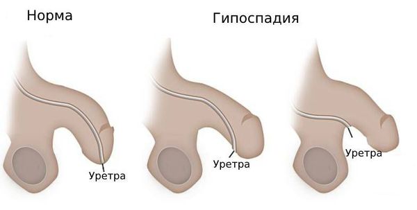 Нормальное расположение наружного отверстия уретры и гипоспадия