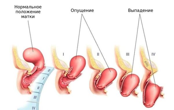 Выпадение и опущение матки